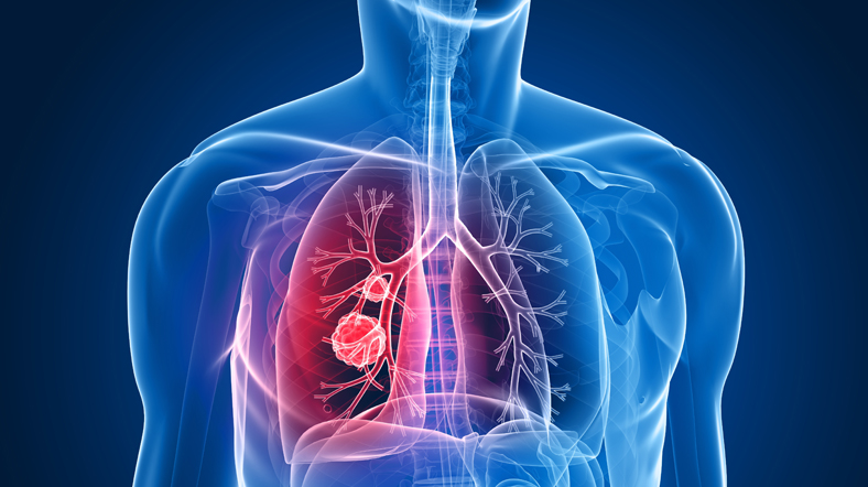akciğer kanseri aşıları üzerindeki araştırmalar sürüyor [fotoğraf: shutterstock]